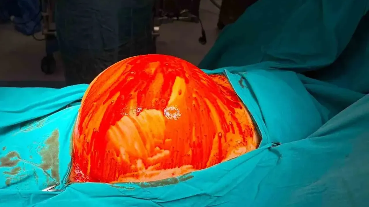Kocaeli Şehir Hastanesi'nde doktorlar gözlerine inanamadı: 6,5 kilogramlık tümör çıkarıldı