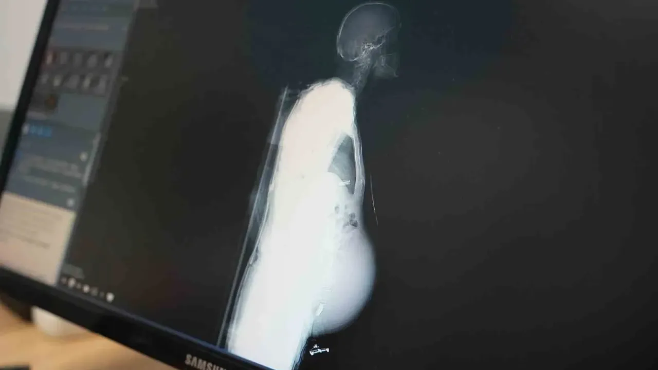 Kocaeli Şehir Hastanesi'nde doktorlar gözlerine inanamadı: 6,5 kilogramlık tümör çıkarıldı